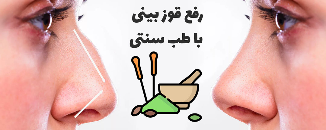 رفع قوز بینی با طب سنتی