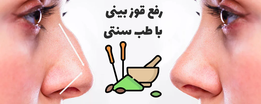 رفع قوز بینی با طب سنتی