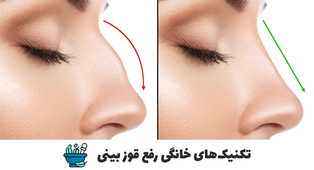 طب سنتی تکنیکهای خانگی برطرف کردن قوز بینی
