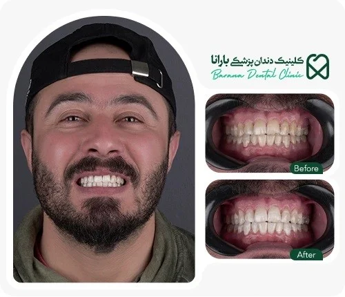 تفاوت هوم بلیچینگ و آفیس بلیچینگ در چیست؟