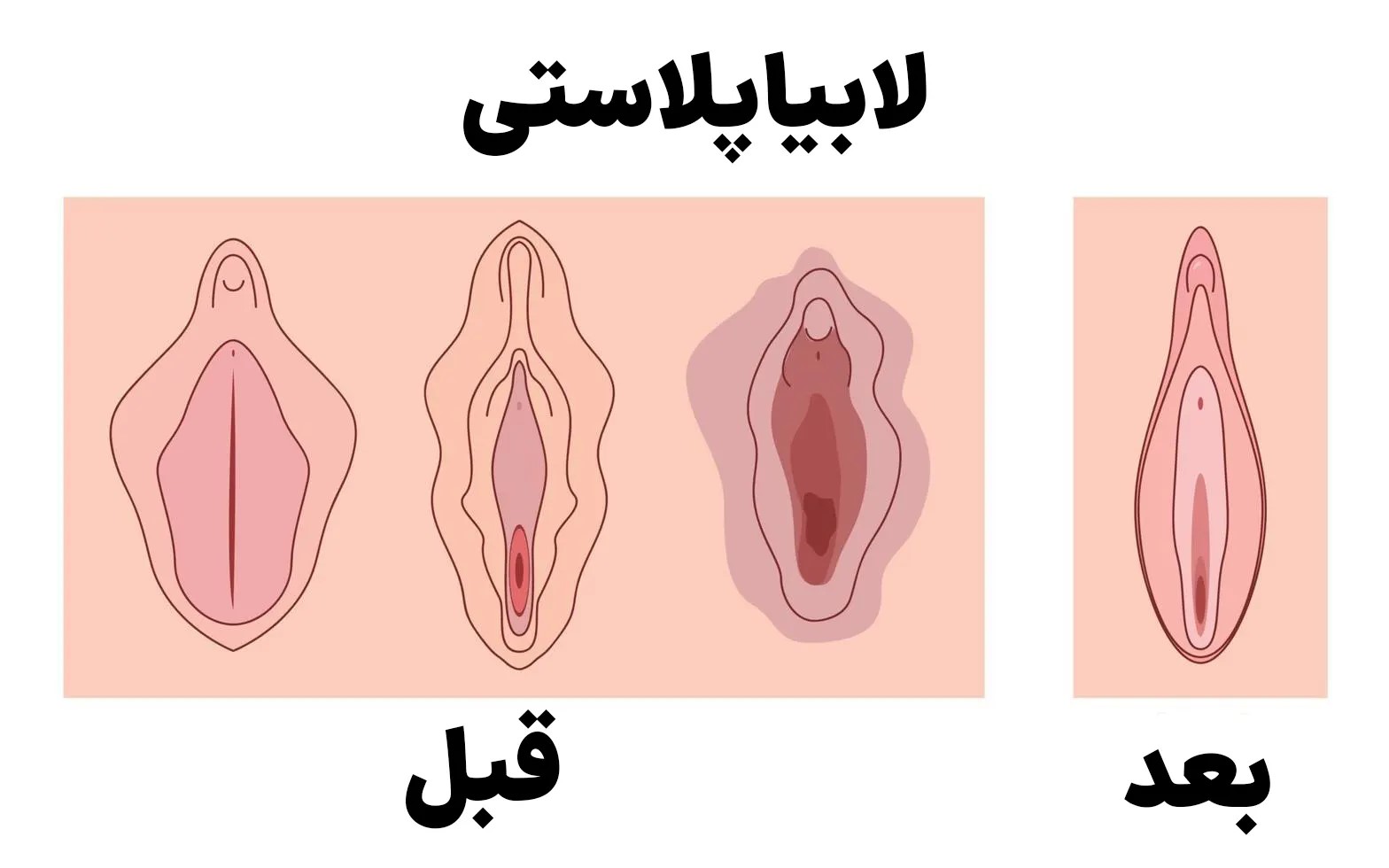 عمل لابیاپلاستی به چند روز استراحت نیاز دارد؟