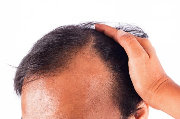 بهترین تونیک ضد ریزش مو برای موهای آسیب دیده از شوره سر